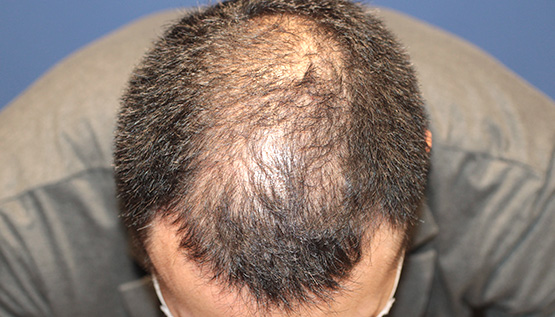30代 男性 S.Y.さん 前頭部 頭頂部 自毛植毛(MIRAI法)2,300株の症例|自毛植毛の症例(手術前)