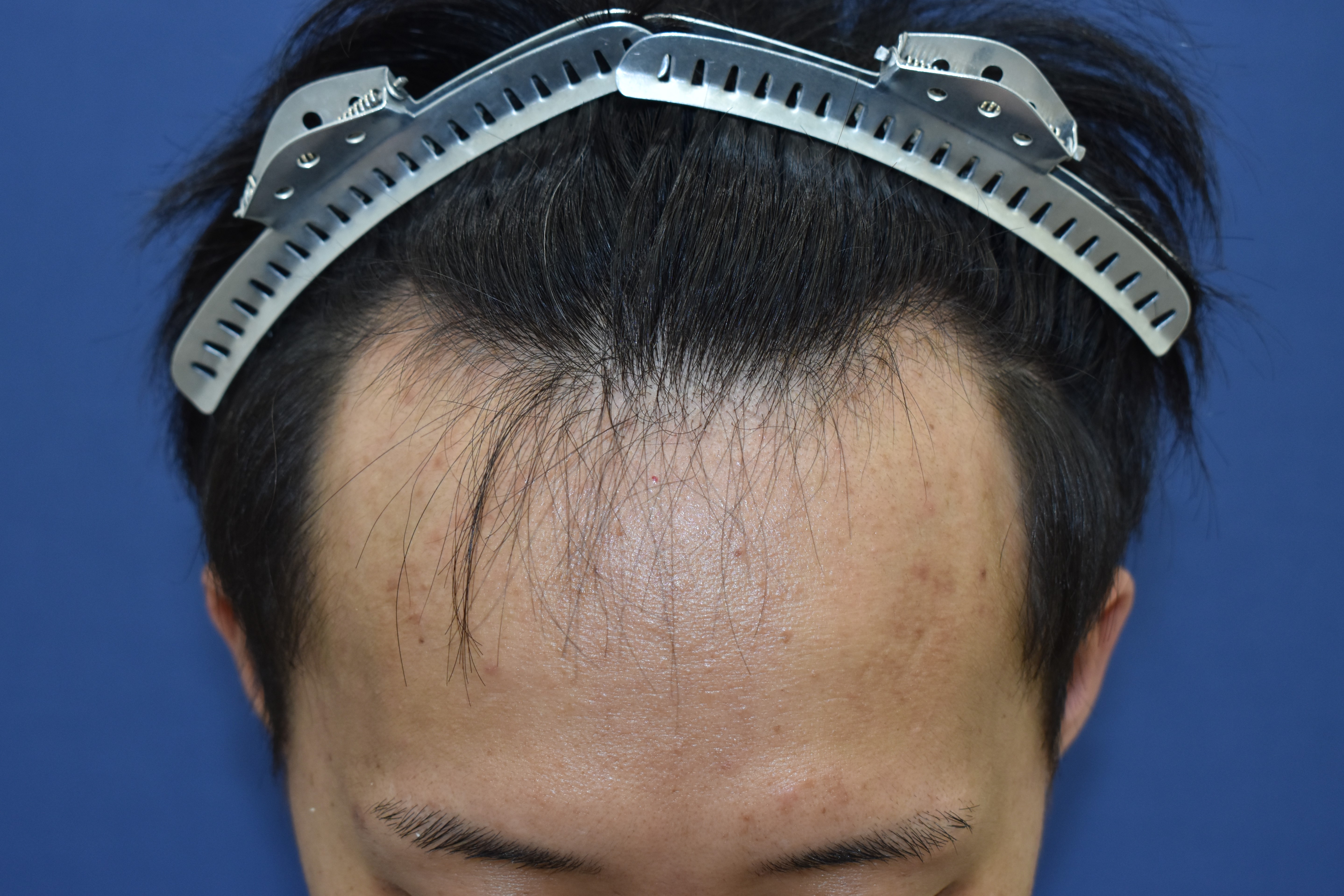 30代 男性 K.N.さん 生え際 自毛植毛(MIRAI法)2,700株の症例|自毛植毛の症例(手術前)