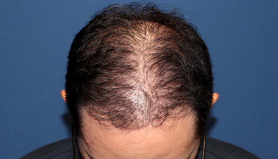 40代 男性 K.N.さん 生え際 前頭部 頭頂部 つむじ 自毛植毛(MIRAI法)3,000株の症例|自毛植毛の症例(手術後)