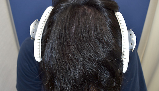 40代 男性 I.M.さん 前頭部・頭頂部・つむじ 自毛植毛(MIRAI法)2,500株の症例|自毛植毛の症例(手術後)