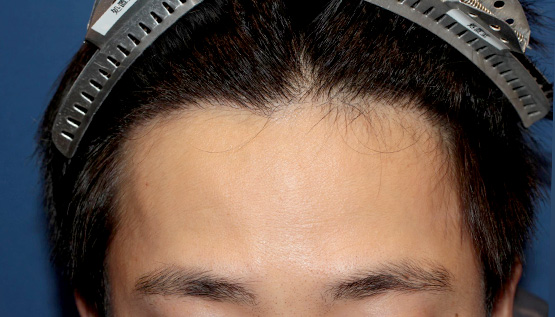30代 男性 Y.M.さん 生え際 自毛植毛(MIRAI法)600株の症例|自毛植毛の症例(手術後)