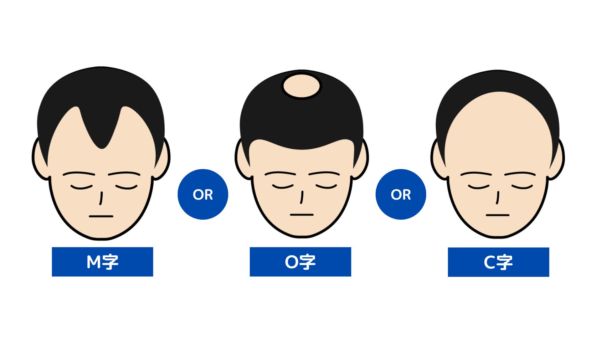 男性の抜け毛の特徴