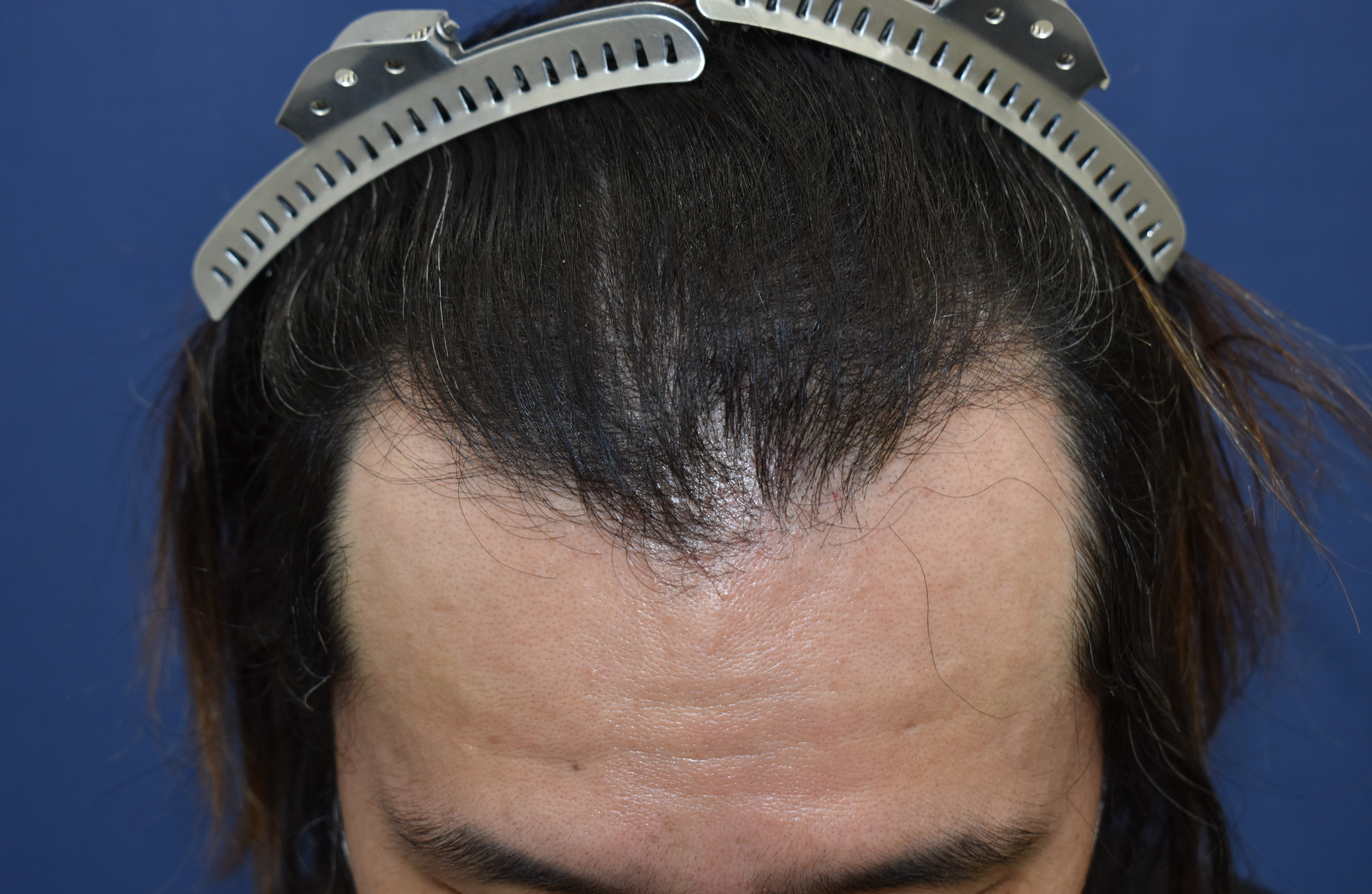 40代 男性 K.I.さん 生え際 前頭部 自毛植毛(MIRAI法)1,500株の症例|自毛植毛の症例(手術前)