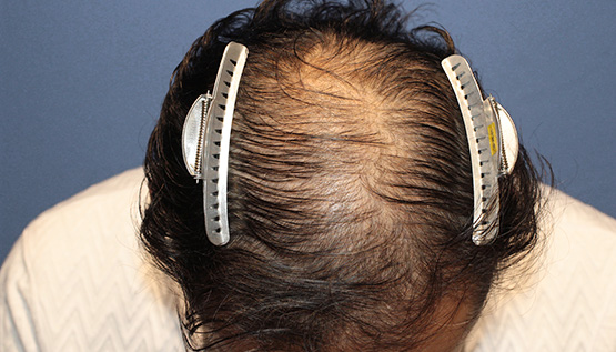 50代 男性 H.O.さん 生え際・前頭部(MIRAI法)2,000株の症例|自毛植毛の症例(手術前)