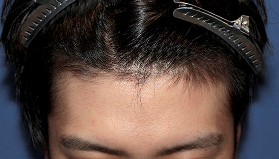 20代 男性 Y.N.さん 生え際 自毛植毛(MIRAI法)1,000株の症例|自毛植毛の症例(手術前)