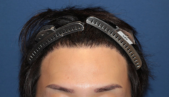 20代 男性 T.E.さん 生え際 自毛植毛(MIRAI法)1,000株の症例|自毛植毛の症例(手術後)