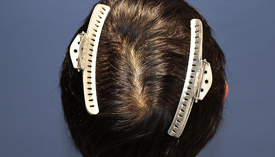 40代 男性 K.A.さん 頭頂部・つむじ 自毛植毛(MIRAI法)600株の症例|自毛植毛の症例(手術前)