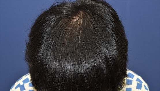 40代 男性 R.T.さん 生え際 自毛植毛(MIRAI法)1,000株の症例|自毛植毛の症例(手術後)